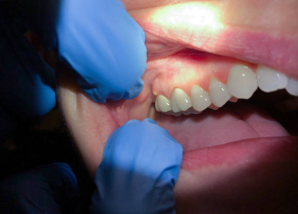 Best Emergency Dental Care for Broken or Chipped Teeth in Hartselle, AL
