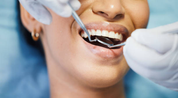 Best Emergency Wisdom Teeth Removal in Hartselle, AL